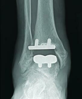Anterior and Lateral Transfibular Approaches Offer Advantages and Tradeoffs in TAA