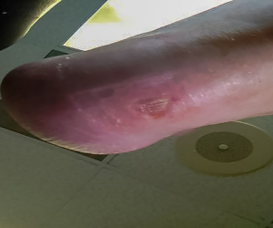 L-methylfolate, Methylcobalamin, and Pyridoxal-5′-Phosphate in Wagner Grade 2 Diabetic Foot Ulcers: A Retrospective Case Series 