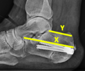 Minimally Invasive Surgical Options for Haglund's Deformity and Retrocalcaneal Heel Pain