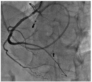 Figure 6. Final angiogram: embolized balloon and sealing of perforation.