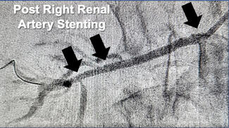Minor Figure 5A. Post Stenting