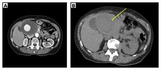 Ferreira_Figure 1_hepatic_artery_aneurysm
