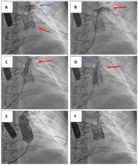 Kakderis_Figure_Melody valve_pulmonary_artery
