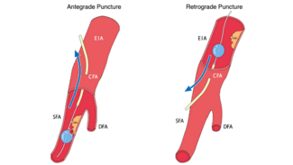 Kazuhiro Figure_mechanism_balloon_rupture_hemostasis_MYNX CONTROL