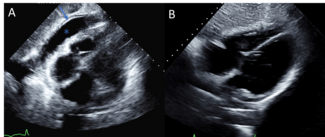 Lerakis_Figure 1_echocardiographic changes