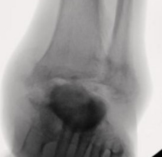 3D-Printed Implant for Charcot Ankle Reconstruction: A Limb Salvage Case Report