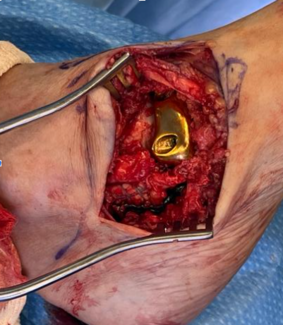 Custom 3D-Printed Navicular Implant for Complex Fracture Reconstruction: A Case Report
