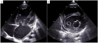 Sahu_Figure_eccentric (hole) type double orifice mitral valve