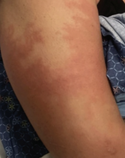 Inflammatory Plaques