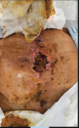 hostile abdomen
