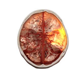 Imaging of acute ischemic stroke