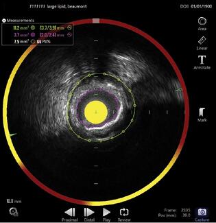 Parikh Figure 2. NIRS-IVUS of the LCx-OM2.