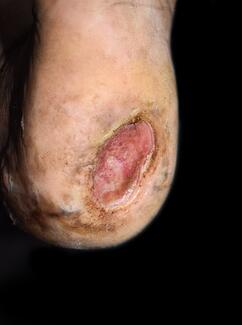 diabetic foot ulcer