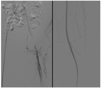 Figure 3. Completion angiogram demonstrating preserved profunda with patent DETOUR system (Endologix).