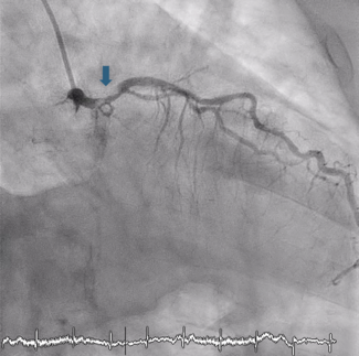 Yau_Figure 1_severe-calcified-stenosis