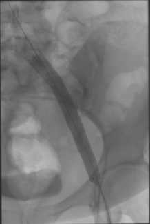 Imaging Corner CLD Figure D - Venovo stent placement.