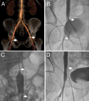 Jaffe_Figure 1_CT_angiography_3D_reconstruction