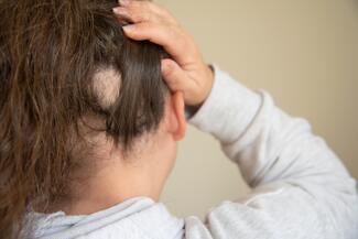 Alopecia