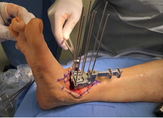 An Update On Incisional Approaches for Total Ankle Replacement 