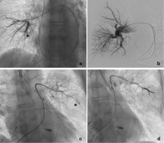 Shah_Figure_Pulmonary-artery-branch-rupture