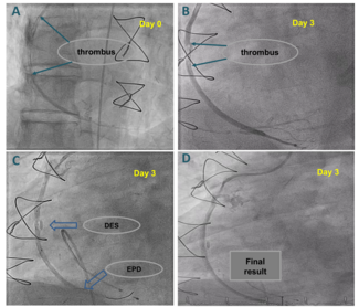 Figure_saphenous-vein-graft-thrombus