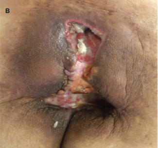 Wound appearance 10 weeks after the initial visit, following incision and drainage for insufficient spontaneous drainage.