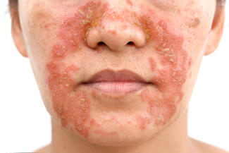 dermatitis