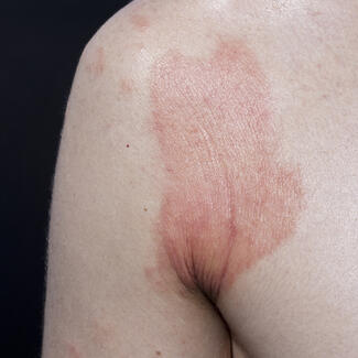 dermatitis