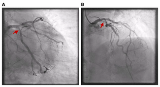 Figure 1_severe-stenosis-circumflex-artery