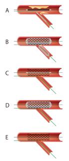 Figure1_modified-jailed-balloon-technique