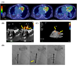 Multimodality-imaging-prosthetic-MV-dysfunction