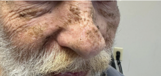 Numerous hyperpigmented, rough-textured patches on the face.