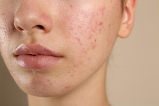 acne on face of an adolescent