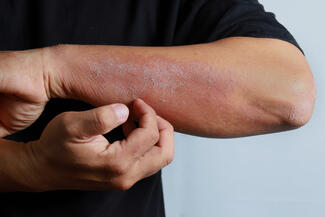 dermatitis