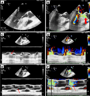Singh_Figure_Dynamic-Left-Ventricular-Outflow-Tract-Obstruction