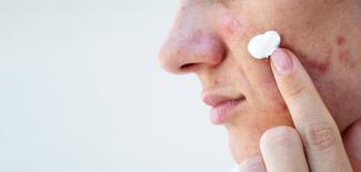 young woman applies acne cream on female face with pimples