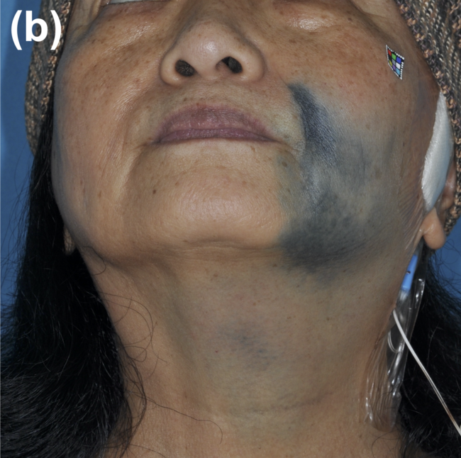 Laser Removal of Buccal Skin Coloration Caused by India Ink Injection ...