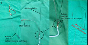Successful Retrieval of Ruptured Stent Balloon Catheter During ...