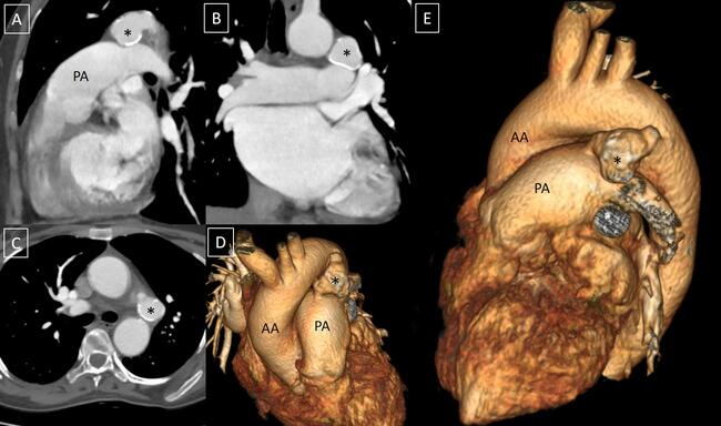 Rare Case of Peripherally Calcified Ductus Arteriosus Aneurysm in an Adult