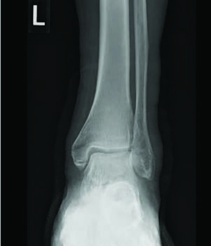 These X-ray images show a mildly displaced isolated medial malleolar fracture in a patient with diabetes, neuropathy, hypertension, PAD and contralateral Charcot. The authors attempted to treat this conservatively with non-weight bearing immobilization.