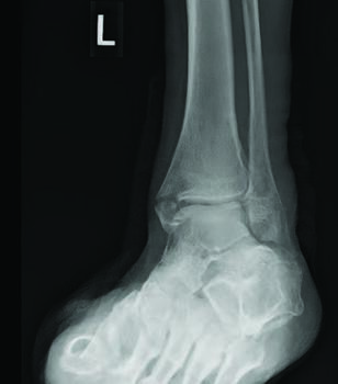 These X-ray images show a mildly displaced isolated medial malleolar fracture in a patient with diabetes, neuropathy, hypertension, PAD and contralateral Charcot. The authors attempted to treat this conservatively with non-weight bearing immobilization.