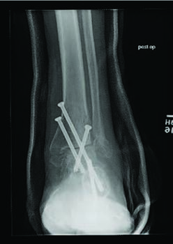 Here one can see radiographic images after the same patient illustrated in the images above ultimately underwent a subtalar and ankle fusion to provide ankle stability and rigidity and prevent complications such as Charcot collapse. The authors inserted all screws percutaneously due to the patient’s tenuous blood flow.
