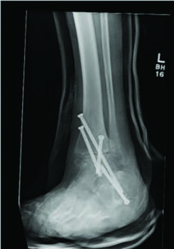 Here one can see radiographic images after the same patient illustrated in the images above ultimately underwent a subtalar and ankle fusion to provide ankle stability and rigidity and prevent complications such as Charcot collapse. The authors inserted all screws percutaneously due to the patient’s tenuous blood flow.