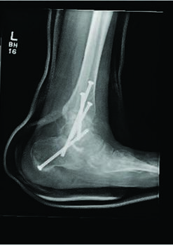 Here one can see radiographic images after the same patient illustrated in the images above ultimately underwent a subtalar and ankle fusion to provide ankle stability and rigidity and prevent complications such as Charcot collapse. The authors inserted all screws percutaneously due to the patient’s tenuous blood flow.