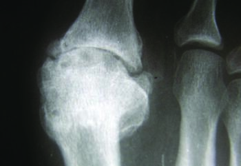 The author relates that it is imperative to understand the etiology of a hallux limitus/ rigidus deformity, the relevant biomechanics and the patient’s gait imbalances when determining appropriate treatment options.