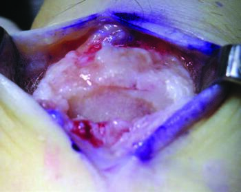 In this intraoperative photo, one can see stage 4 hallux rigidus with loss of articular cartilage.