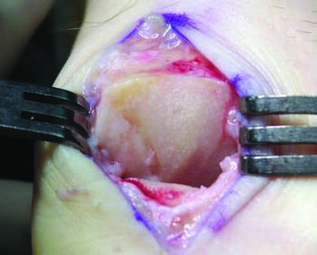 At this stage, lack of range of motion and osteoarthritis can cause significant pain for patients.