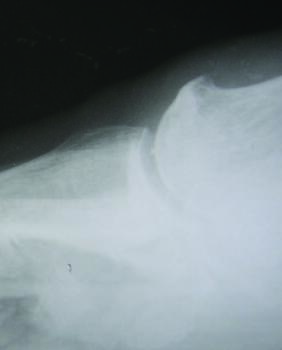 A high toe box may prevent a dorsal osteophyte or metatarsus primus elevatus (as seen here) from impinging on a shoe.