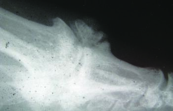 Although early changes can be subtle, as hallux limitus progresses, radiographic findings may reveal various radiographic findings including possible fracture fragments or loose bodies, as seen in this image.
