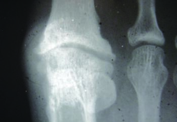 In this radiographic image, one can see a stage 3 to 4 hallux limitus/rigidus deformity. If conservative treatment efforts are not successful, the physician should take care to address attainable goals with the patient prior to surgical intervention.